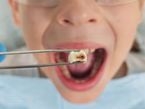 Best Emergency Treatment for Dental Infections or Abscesses in Springdale, MD